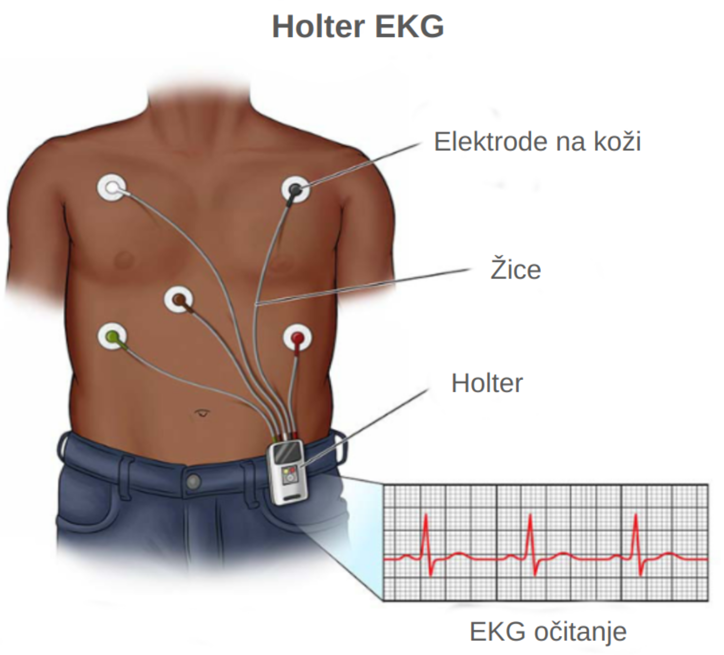 Holter EKG srca postavljen na prsa bilježi aktivnost srca 24 sata