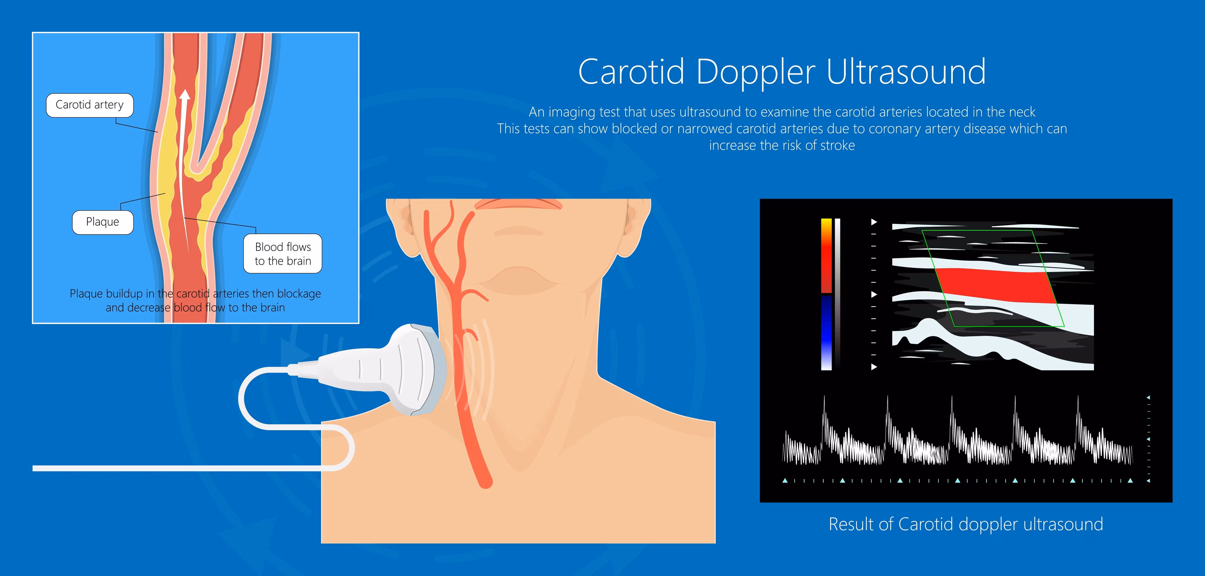 color-doppler-cd-karotida